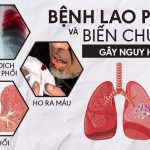 benh-lao-phoi-va-bien-chung